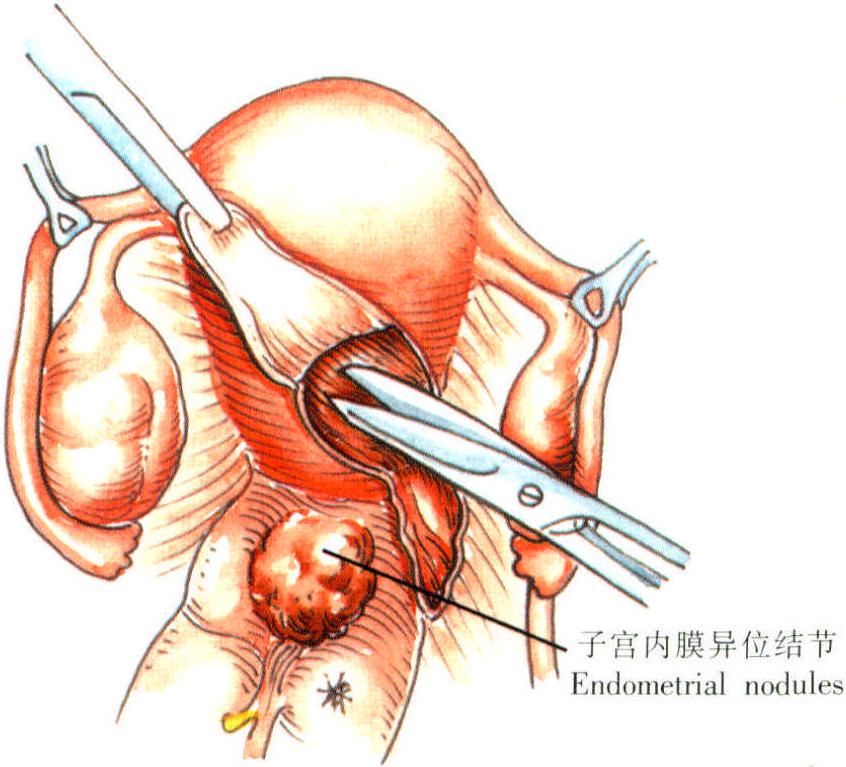 子宫的样子手术图片